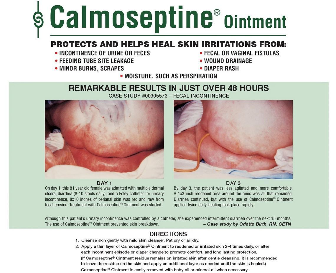 Calmoseptine zinc oxide ointment - helps heal skin irritations