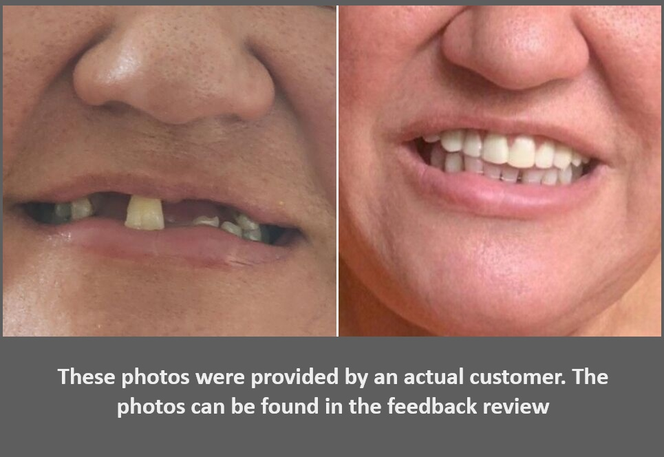 Instant Smile Comfort Fit Flex - temporary snap-on fake tooth cosmetic appearance solution