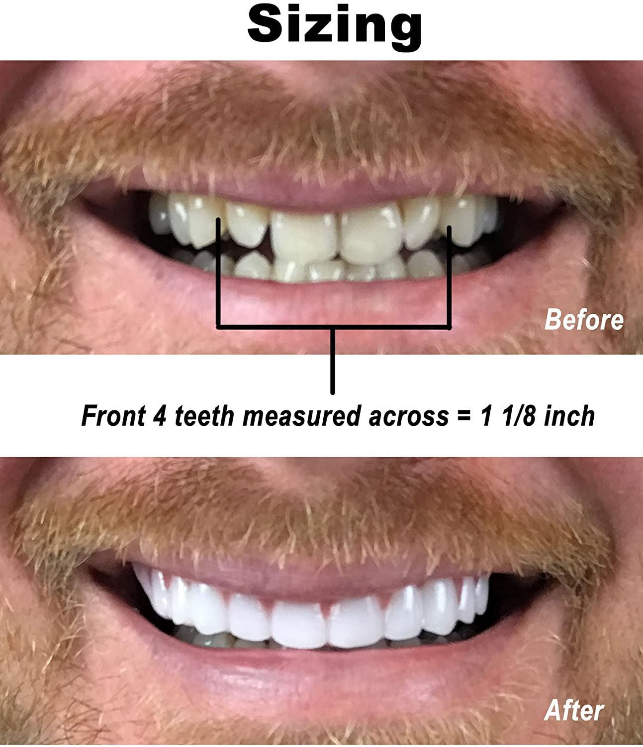 Instant Smile Comfort Fit Flex - temporary snap-on fake tooth cosmetic appearance solution - before and after